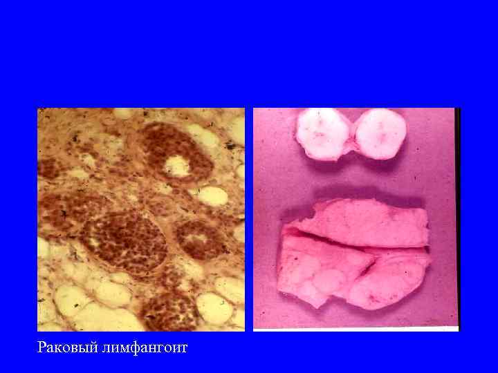 Раковый лимфангоит 