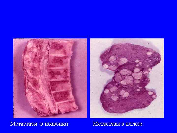 Метастазы в позвонки Метастазы в легкое 