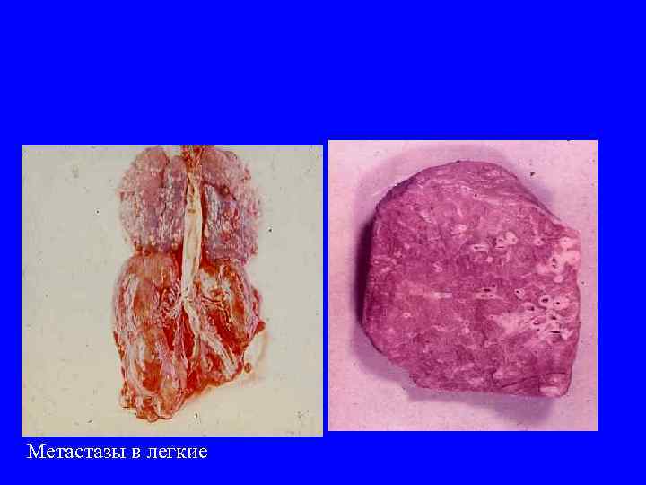 Метастазы в легкие 
