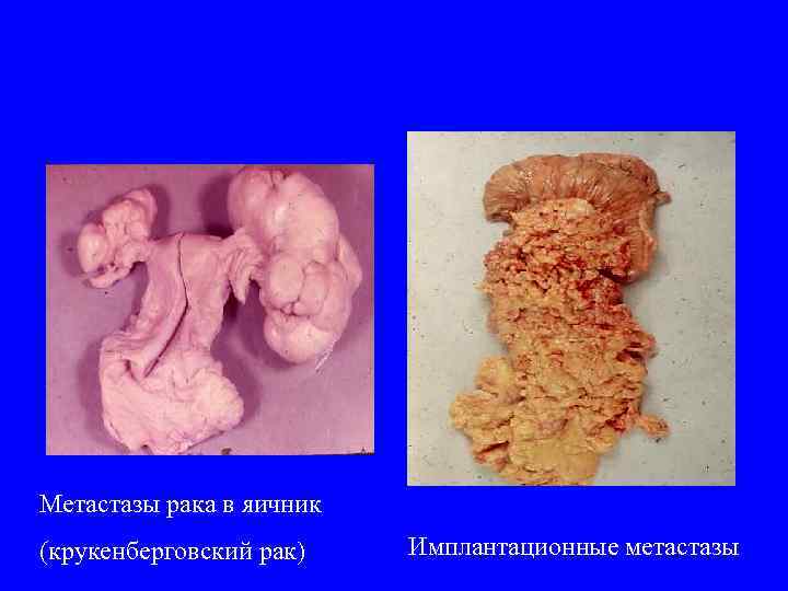 Метастазы рака в яичник (крукенберговский рак) Имплантационные метастазы 