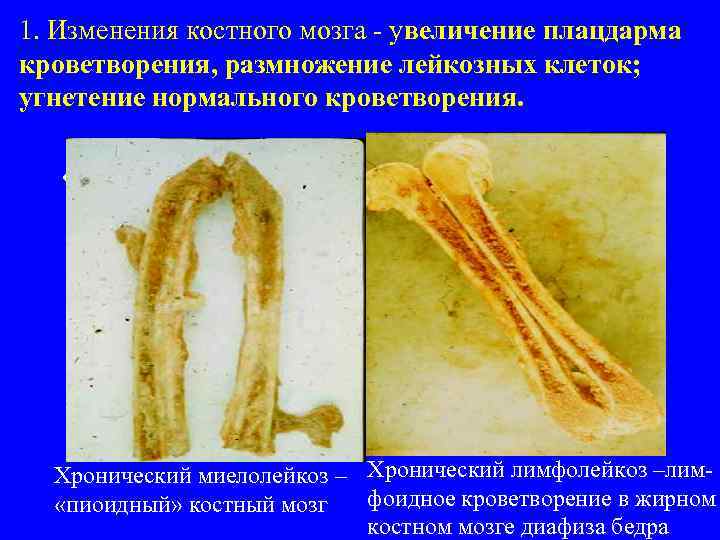 1. Изменения костного мозга - увеличение плацдарма кроветворения, размножение лейкозных клеток; угнетение нормального кроветворения.