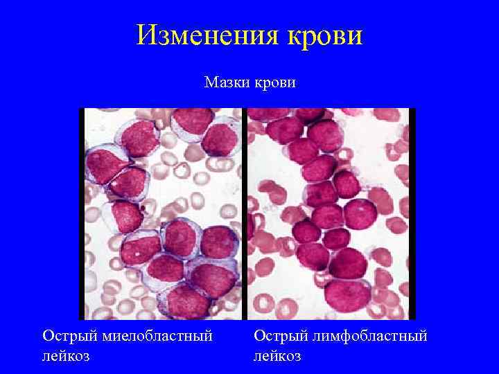 Изменения крови Мазки крови Острый миелобластный лейкоз Острый лимфобластный лейкоз 
