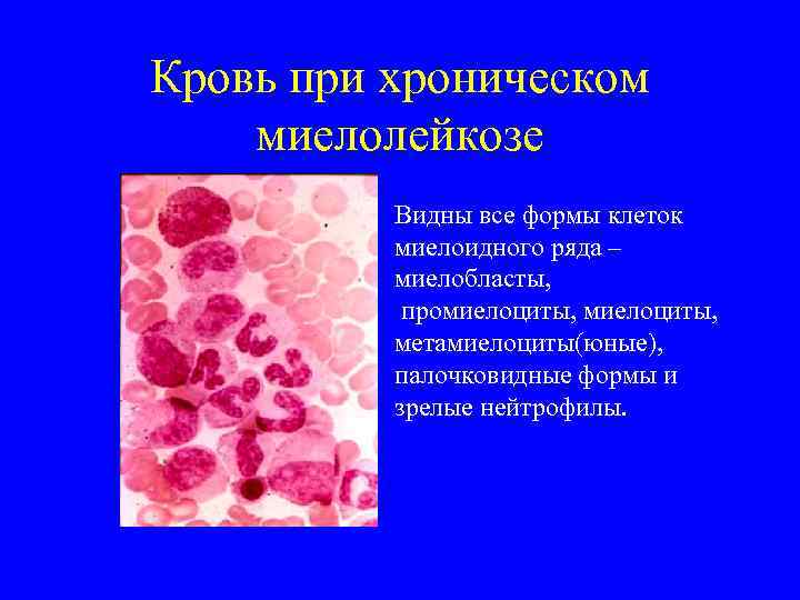 Кровь при хроническом миелолейкозе Видны все формы клеток миелоидного ряда – миелобласты, промиелоциты, метамиелоциты(юные),