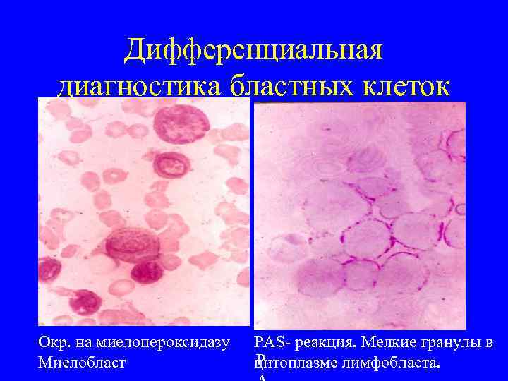 Дифференциальная диагностика бластных клеток Окр. на миелопероксидазу Миелобласт PAS- реакция. Мелкие гранулы в P