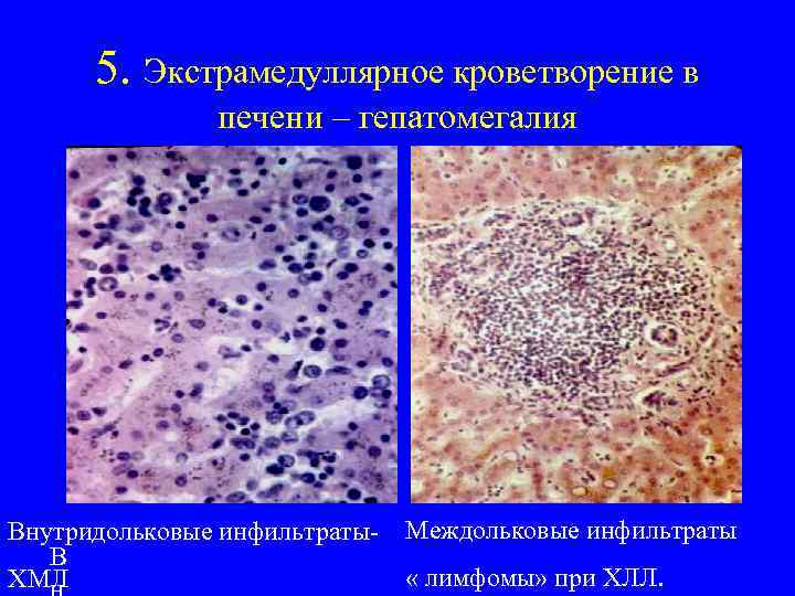 5. Экстрамедуллярное кроветворение в печени – гепатомегалия Внутридольковые инфильтраты. В ХМЛ Междольковые инфильтраты «