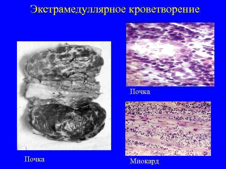 Экстрамедуллярное кроветворение Почка Миокард 