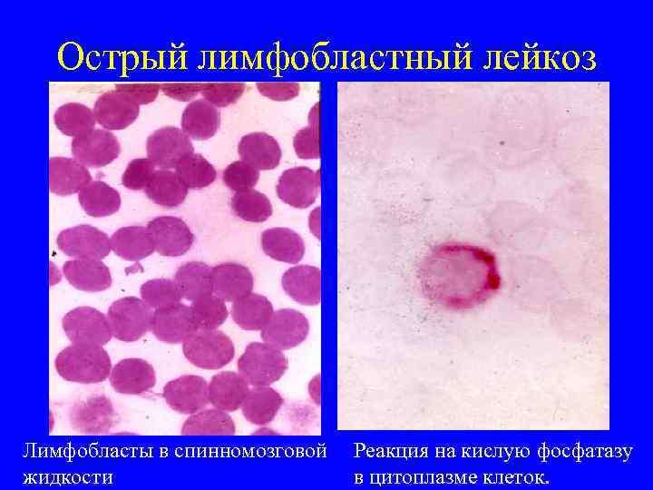 Острый лимфобластный лейкоз Лимфобласты в спинномозговой жидкости Реакция на кислую фосфатазу в цитоплазме клеток.
