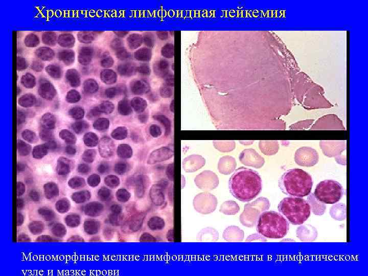 Хроническая лимфоидная лейкемия Мономорфные мелкие лимфоидные элементы в димфатическом узле и мазке крови 