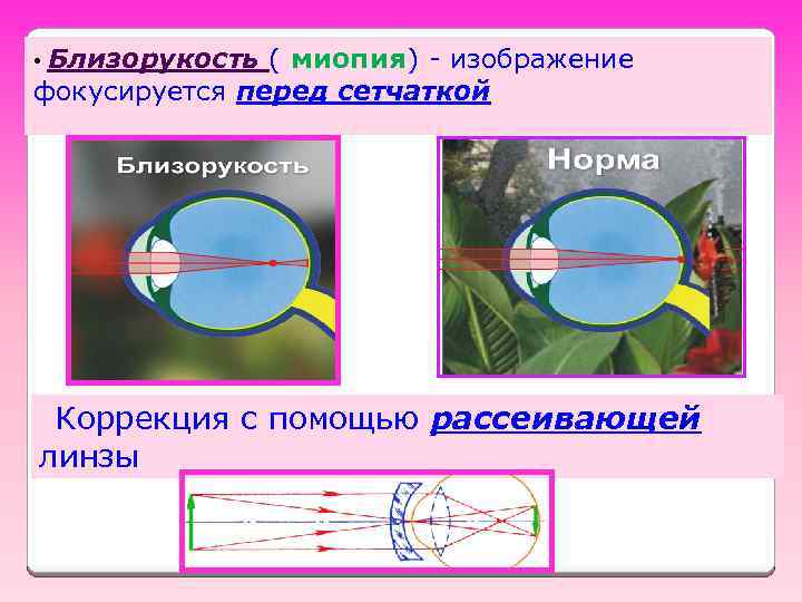 Близорукость ( миопия) - изображение фокусируется перед сетчаткой • Коррекция с помощью рассеивающей линзы