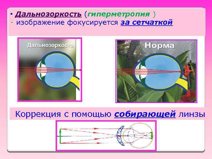  • Дальнозоркость (гиперметропия ) - изображение фокусируется за сетчаткой Коррекция с помощью собирающей