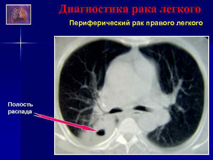 Диагностика рака легкого Периферический рак правого легкого Полость распада 