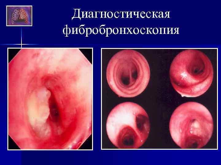 Диагностическая фибробронхоскопия 