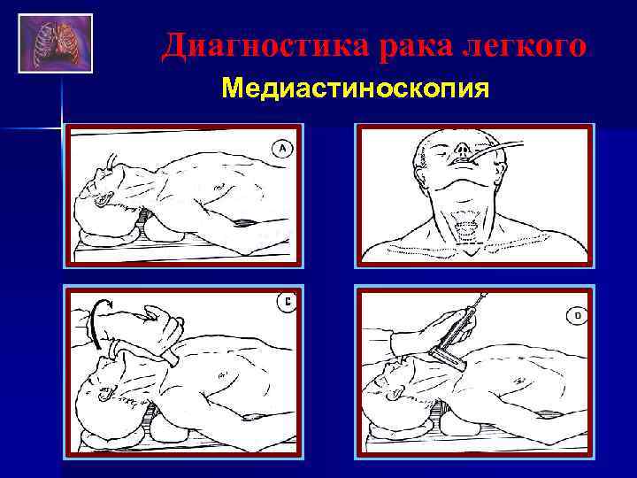 Диагностика рака легкого Медиастиноскопия 