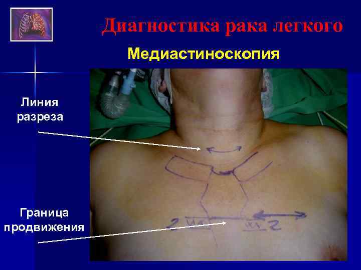 Диагностика рака легкого Медиастиноскопия Линия разреза Граница продвижения 