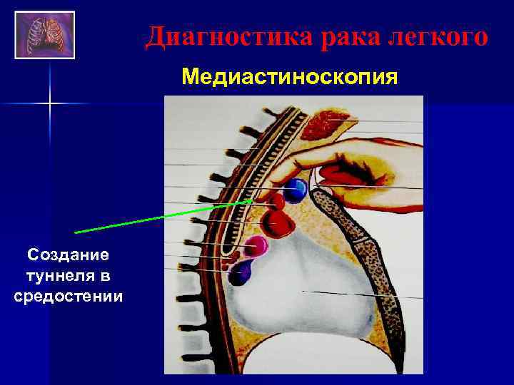 Диагностика рака легкого Медиастиноскопия Создание туннеля в средостении 