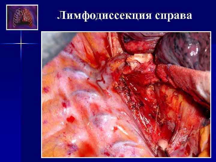 Лимфодиссекция справа 