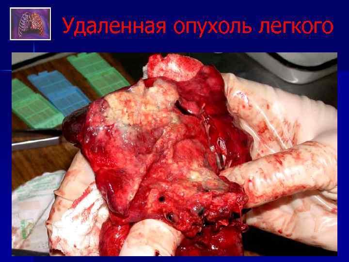 Удаленная опухоль легкого 