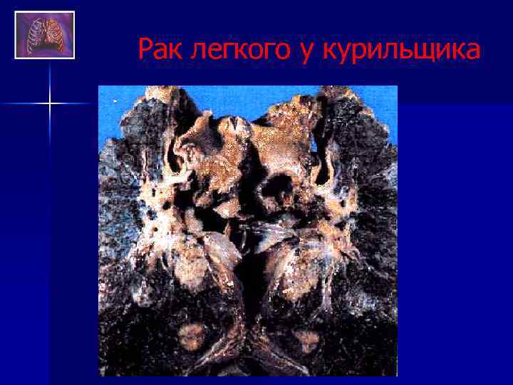 Рак легкого у курильщика 