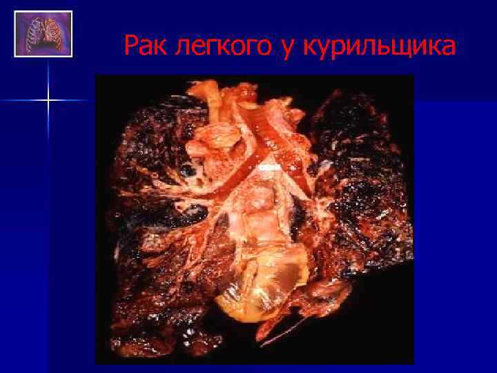 Рак легкого у курильщика 