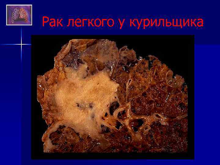 Рак легкого у курильщика 