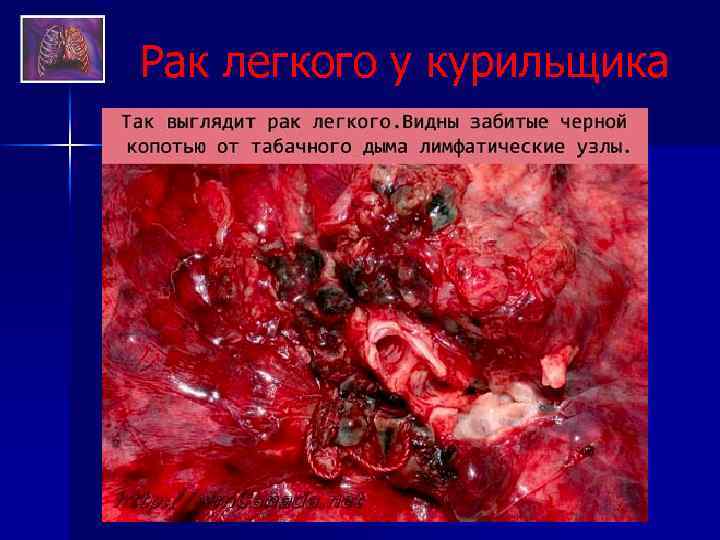 Рак легкого у курильщика 