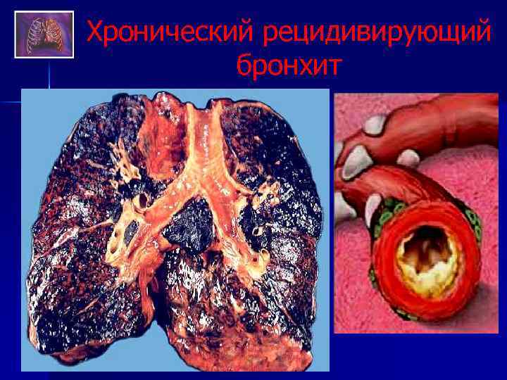Хронический рецидивирующий бронхит 
