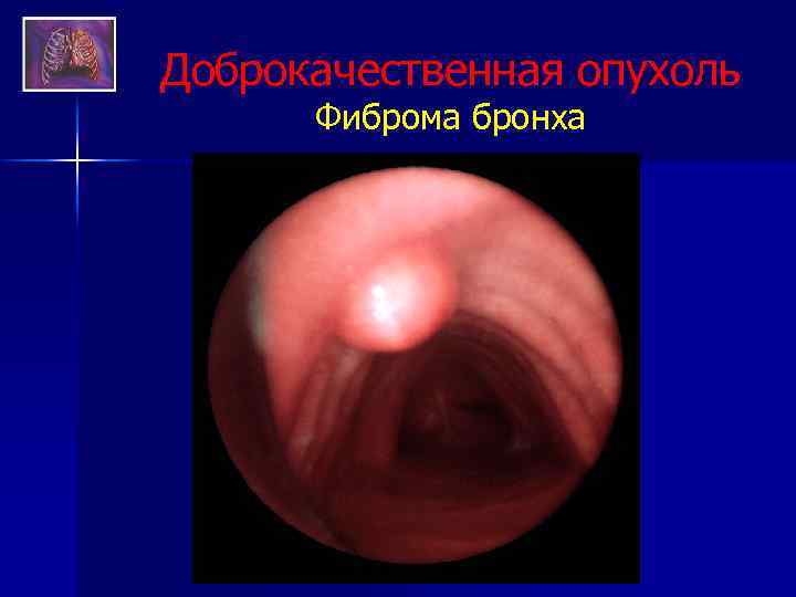 Доброкачественная опухоль Фиброма бронха 