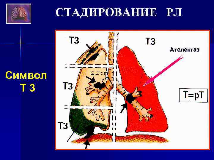 СТАДИРОВАНИЕ РЛ Ателектаз Символ Т 3 