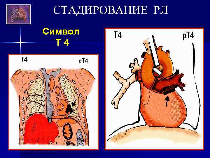 СТАДИРОВАНИЕ РЛ Символ Т 4 