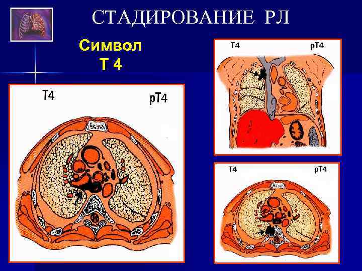 СТАДИРОВАНИЕ РЛ Символ Т 4 