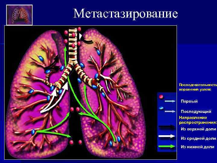 Метастазирование Последовательность поражения узлов: Первый Последующий Направление распространения: Из верхней доли Из средней доли