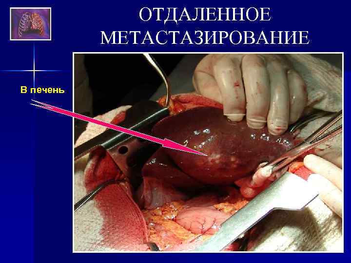 ОТДАЛЕННОЕ МЕТАСТАЗИРОВАНИЕ В печень 