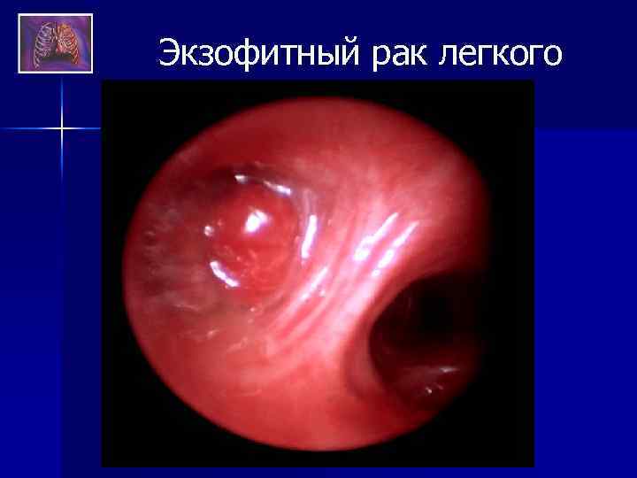 Экзофитный рак легкого 