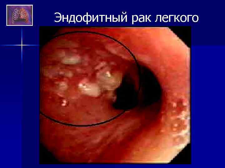 Эндофитный рак легкого 
