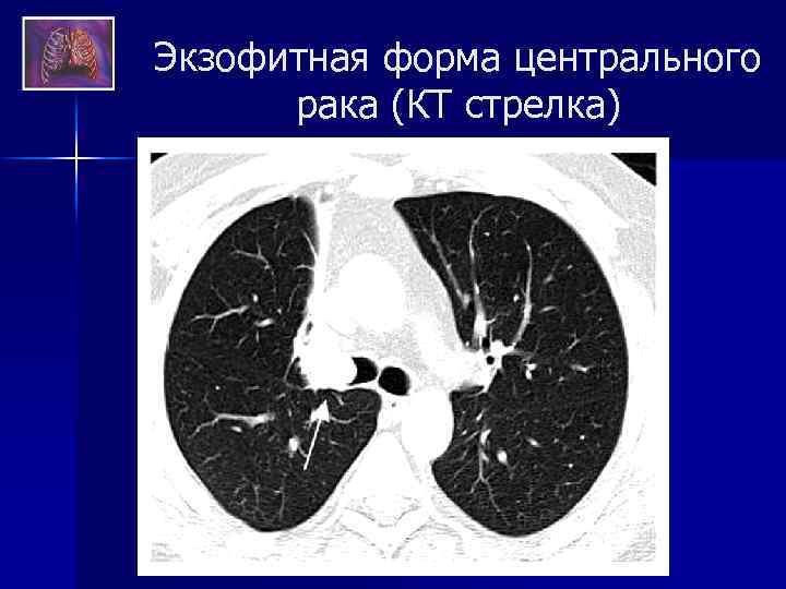 Центральный рак кт. Экзофитная опухоль легкого.