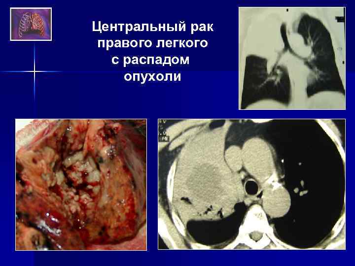 Центральный рак правого легкого с распадом опухоли 