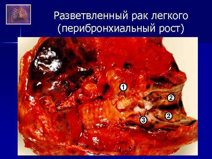 Разветвленный рак легкого (перибронхиальный рост) 