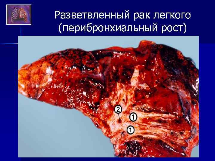 Разветвленный рак легкого (перибронхиальный рост) 