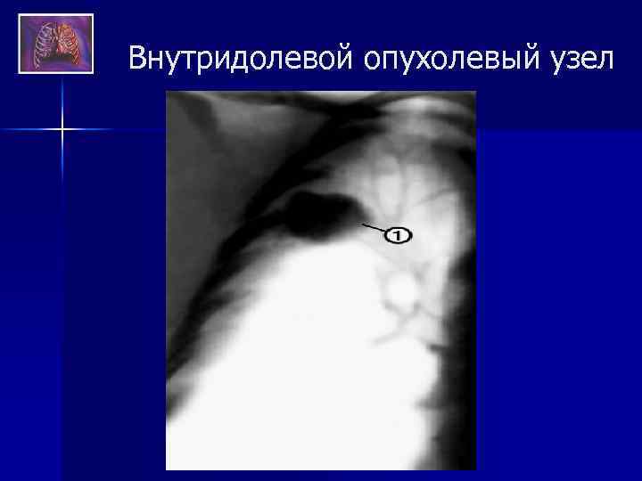 Внутридолевой опухолевый узел 