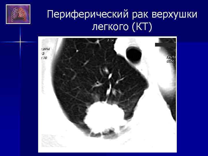 Периферический рак верхушки легкого (КТ) 