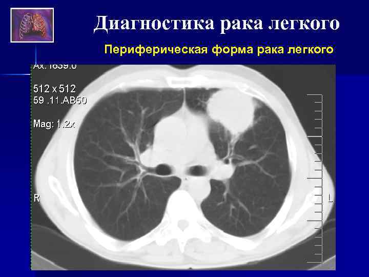 Диагноз периферический рак. Множественные тонкостенные полости по периферии легкого.