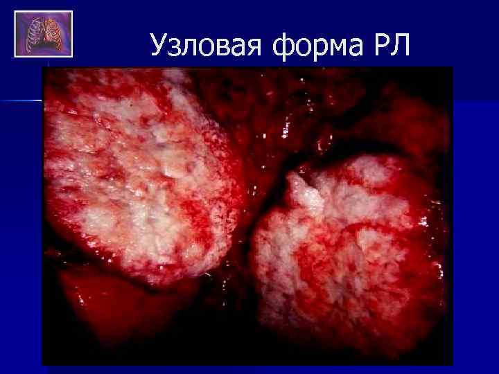 Узловая форма РЛ 