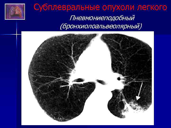 Бронхоальвеолярный рак презентация