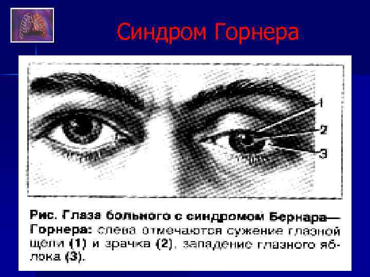 Синдром Горнера 