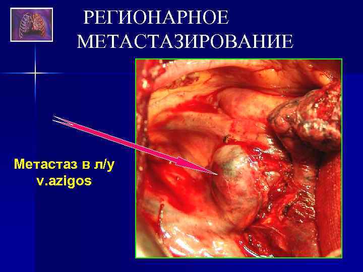 РЕГИОНАРНОЕ МЕТАСТАЗИРОВАНИЕ Метастаз в л/у v. azigos 