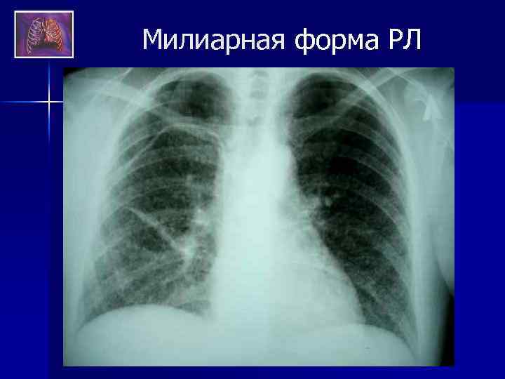 Милиарная форма РЛ 