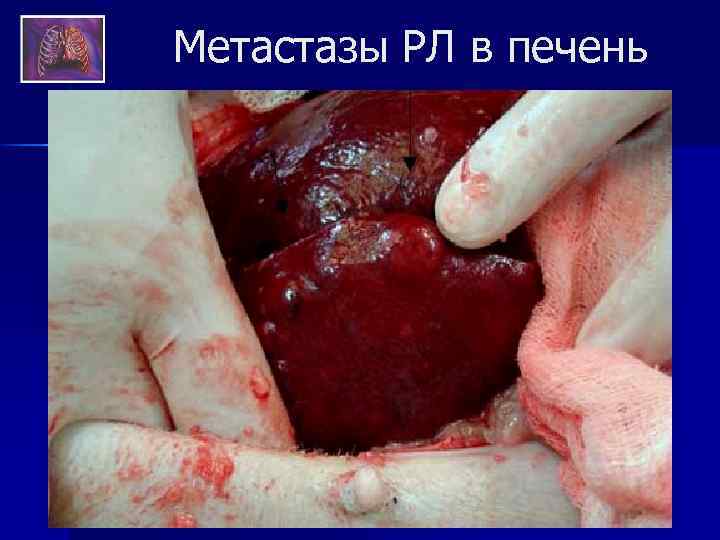 Метастазы РЛ в печень 