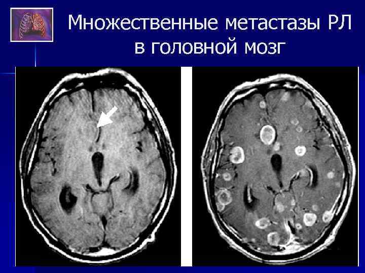 Множественные метастазы РЛ в головной мозг 