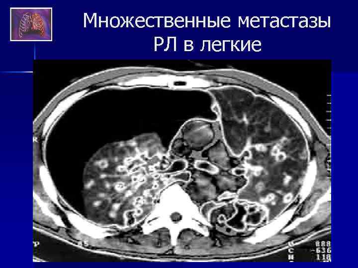 Множественные метастазы РЛ в легкие 