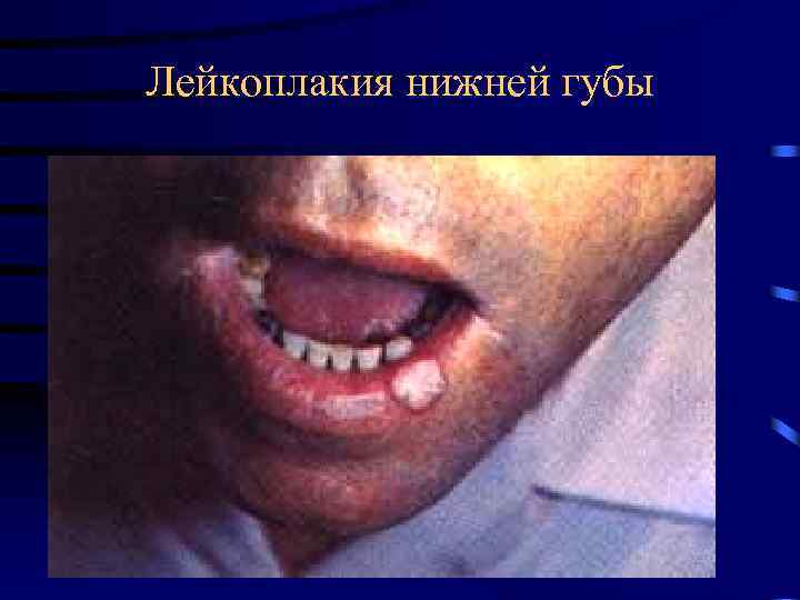 Лейкоплакия нижней губы 